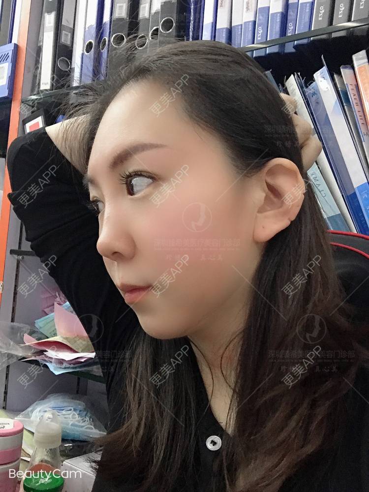 更美 - 杨宝宝😊啊的埋线提升经验 | 埋线提升 | 深圳