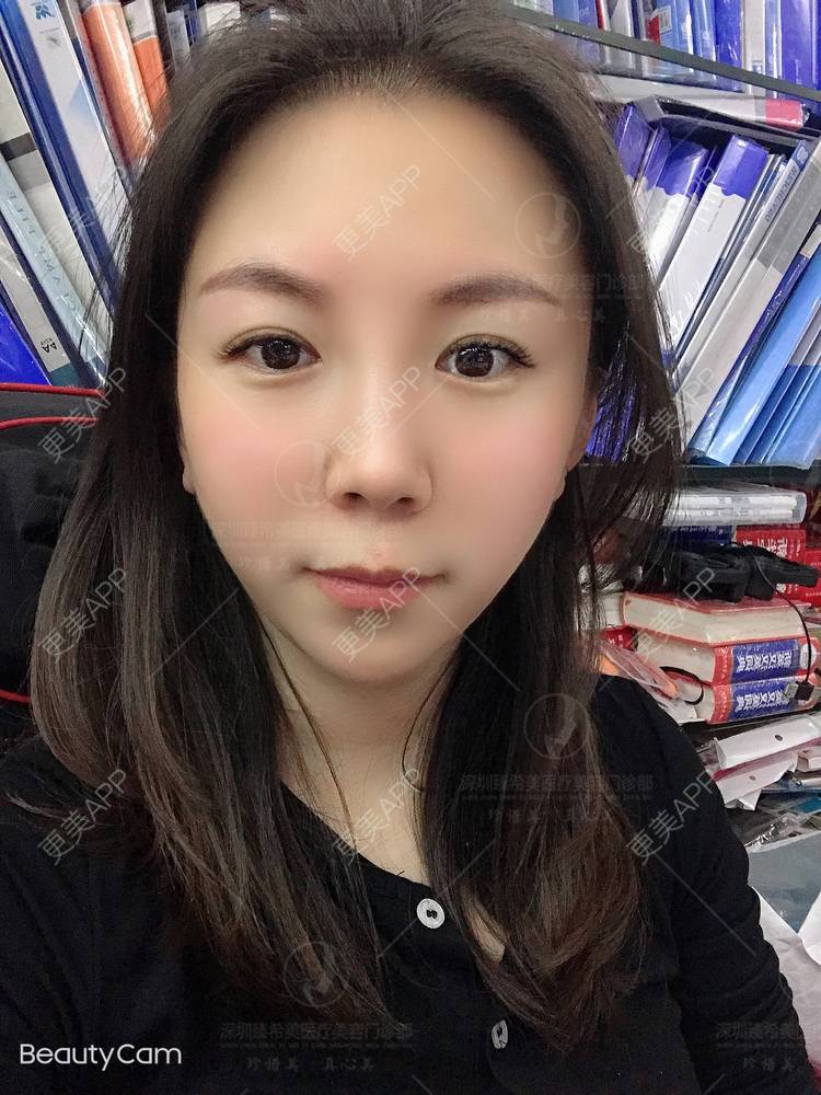 更美 - 杨宝宝😊啊的埋线提升经验 | 埋线提升 | 深圳