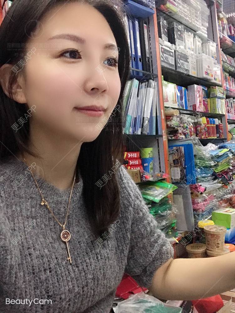 更美 - 杨宝宝😊啊的埋线提升经验 | 埋线提升 | 深圳