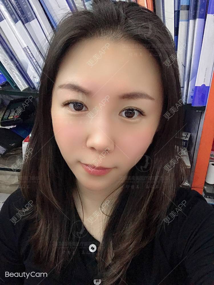 更美 - 杨宝宝😊啊的埋线提升经验 | 埋线提升 | 深圳