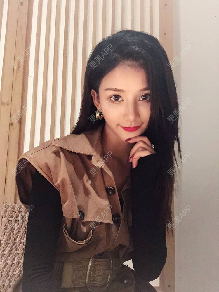 更美 - 双子座的小易的隆鼻经验 | 隆鼻 | 手术缩鼻头 | 长沙 | 鼻小柱延长 | 鼻形态修复 | 鼻部硅胶假体取出 | 耳软骨隆鼻