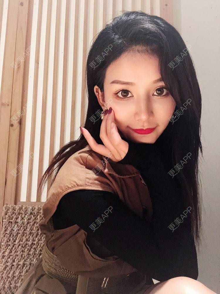 更美 - 双子座的小易的隆鼻经验 | 隆鼻 | 手术缩鼻头 | 长沙 | 鼻小柱延长 | 鼻形态修复 | 鼻部硅胶假体取出 | 耳软骨隆鼻