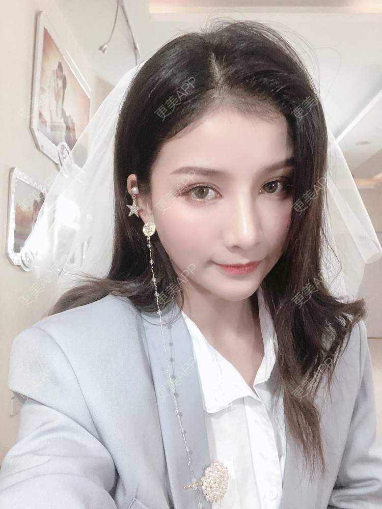 更美 - 双子座的小易的隆鼻经验 | 隆鼻 | 手术缩鼻头 | 长沙 | 鼻小柱延长 | 鼻形态修复 | 鼻部硅胶假体取出 | 耳软骨隆鼻