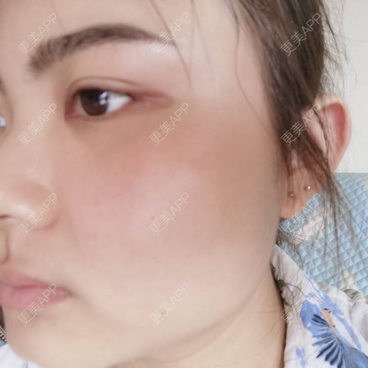 更美 - 不一“斑”的人的激光淡化红血丝经验 | 祛斑祛色素 | 化学剥脱淡斑 | 激光淡斑 | 皮秒激光 | 淡斑套餐
