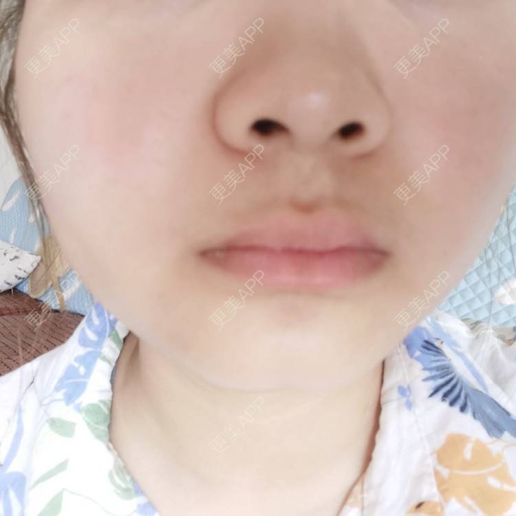 更美 - 不一“斑”的人的激光淡化红血丝经验 | 祛斑祛色素 | 化学剥脱淡斑 | 激光淡斑 | 皮秒激光 | 淡斑套餐