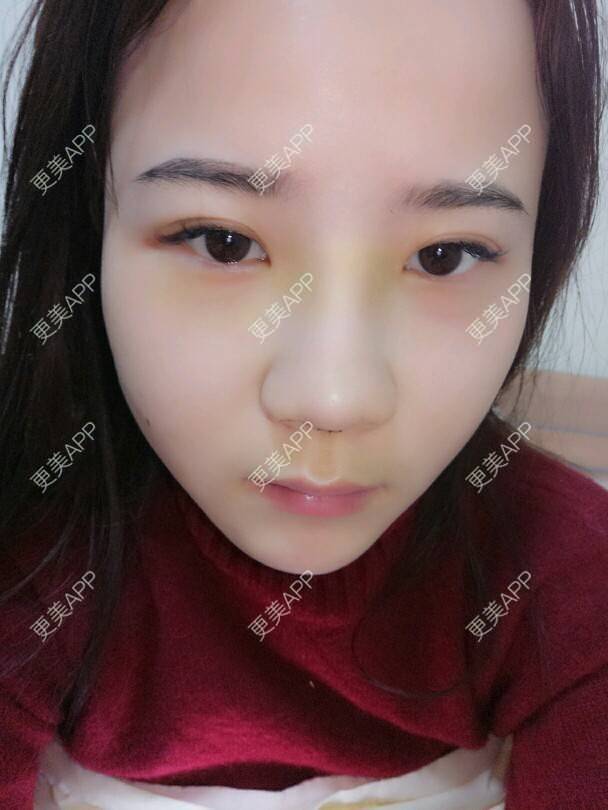 更美 - 美丽与智慧兼并的隆鼻经验 | 隆鼻 | 下巴截骨前移 | 硅胶垫下巴 | 膨体垫下巴 | 成都