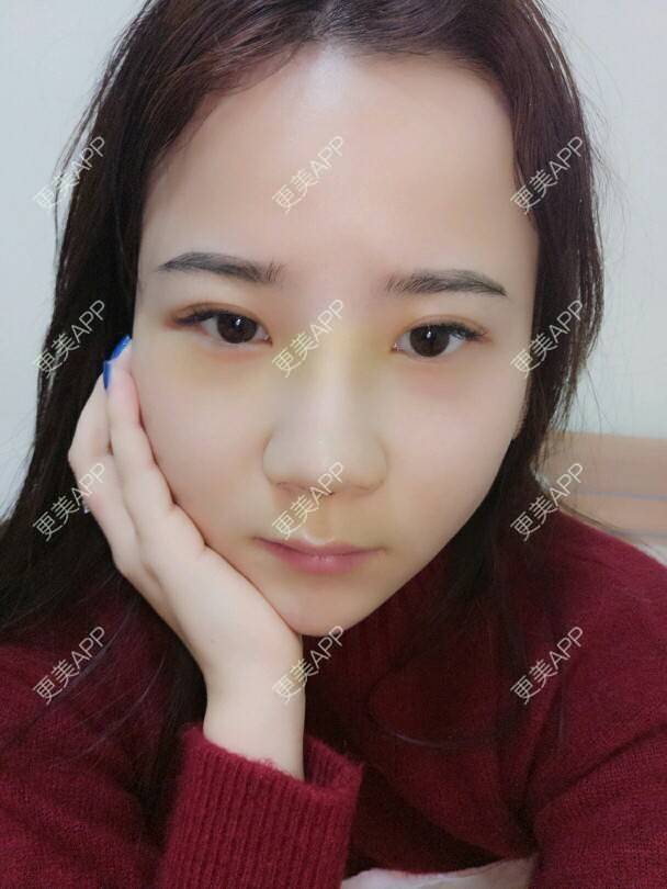 更美 - 美丽与智慧兼并的隆鼻经验 | 隆鼻 | 下巴截骨前移 | 硅胶垫下巴 | 膨体垫下巴 | 成都