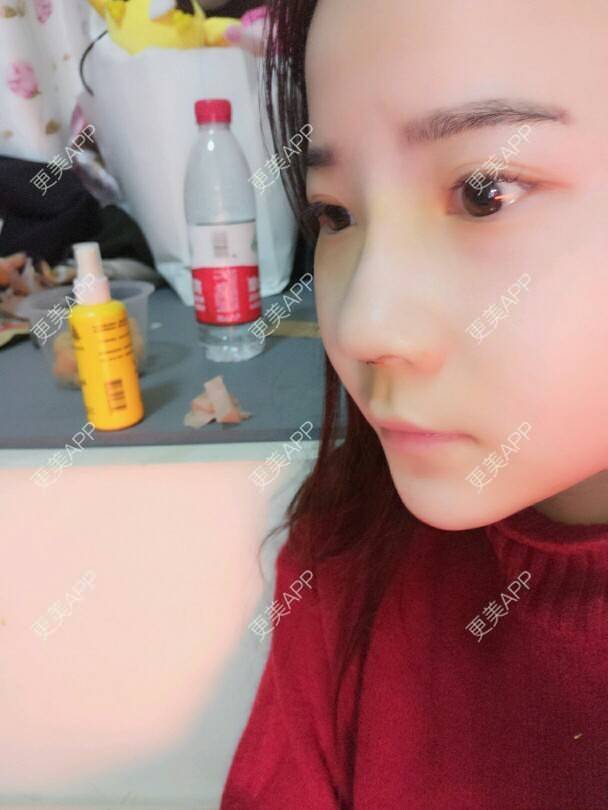 更美 - 美丽与智慧兼并的隆鼻经验 | 隆鼻 | 下巴截骨前移 | 硅胶垫下巴 | 膨体垫下巴 | 成都