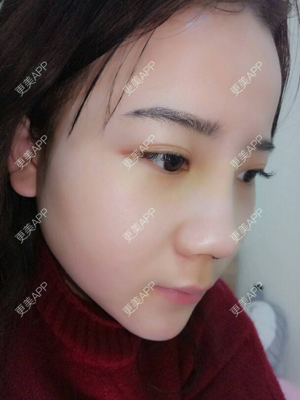 更美 - 美丽与智慧兼并的隆鼻经验 | 隆鼻 | 下巴截骨前移 | 硅胶垫下巴 | 膨体垫下巴 | 成都