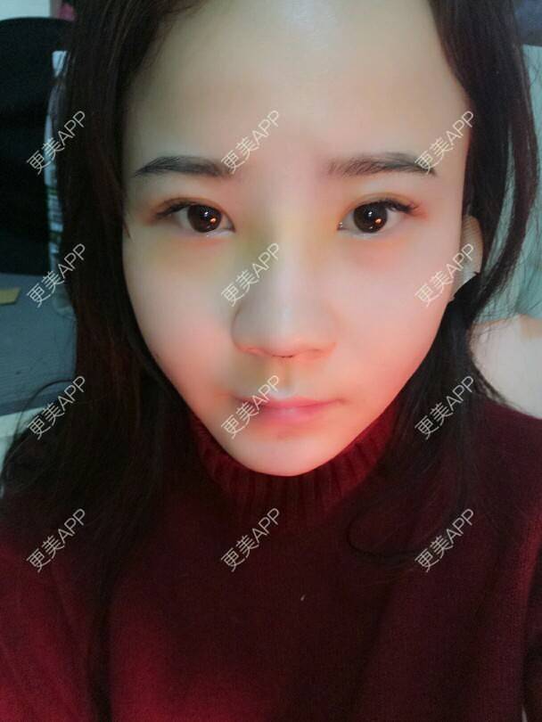 更美 - 美丽与智慧兼并的隆鼻经验 | 隆鼻 | 下巴截骨前移 | 硅胶垫下巴 | 膨体垫下巴 | 成都