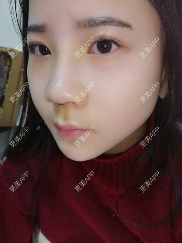 更美 - 美丽与智慧兼并的隆鼻经验 | 隆鼻 | 下巴截骨前移 | 硅胶垫下巴 | 膨体垫下巴 | 成都