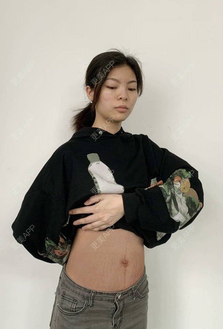 更美 - 原来你在这里💚的妊娠纹经验 | 综合淡疤 | 更美研究所 | 妊娠纹 | 成都