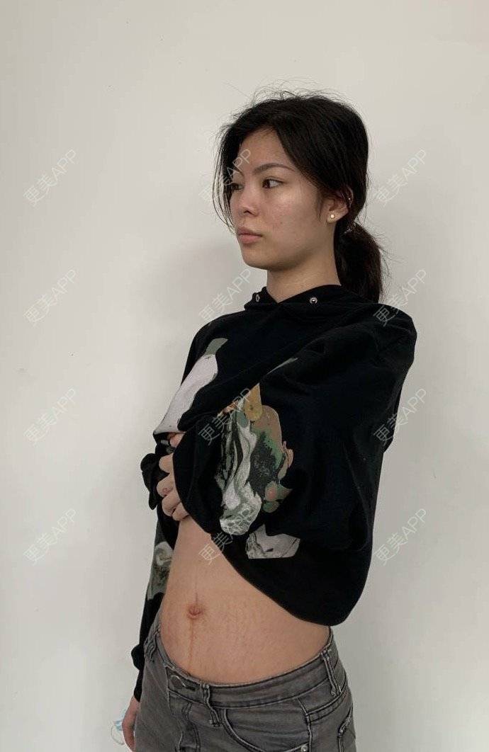 更美 - 原来你在这里💚的妊娠纹经验 | 综合淡疤 | 更美研究所 | 妊娠纹 | 成都