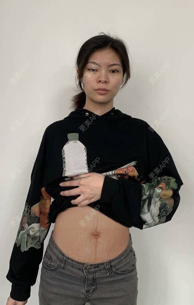 更美 - 原来你在这里💚的妊娠纹经验 | 综合淡疤 | 更美研究所 | 妊娠纹 | 成都