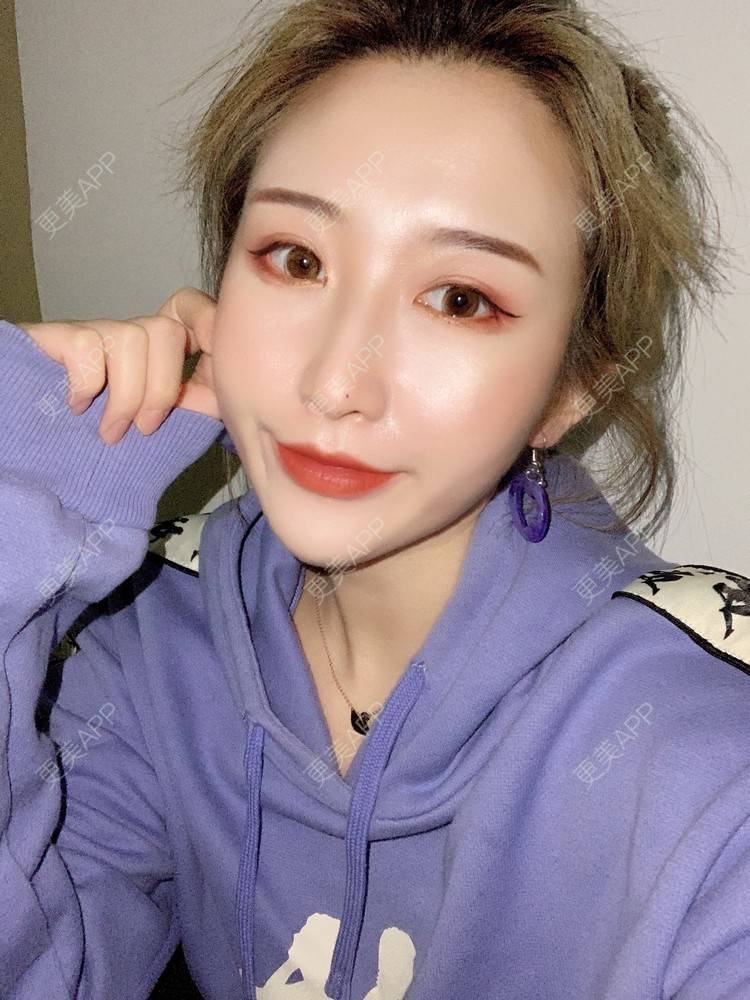 更美 - 更美用户KtaWOoiEh5的埋线提升经验 | 埋线提升 | 东莞