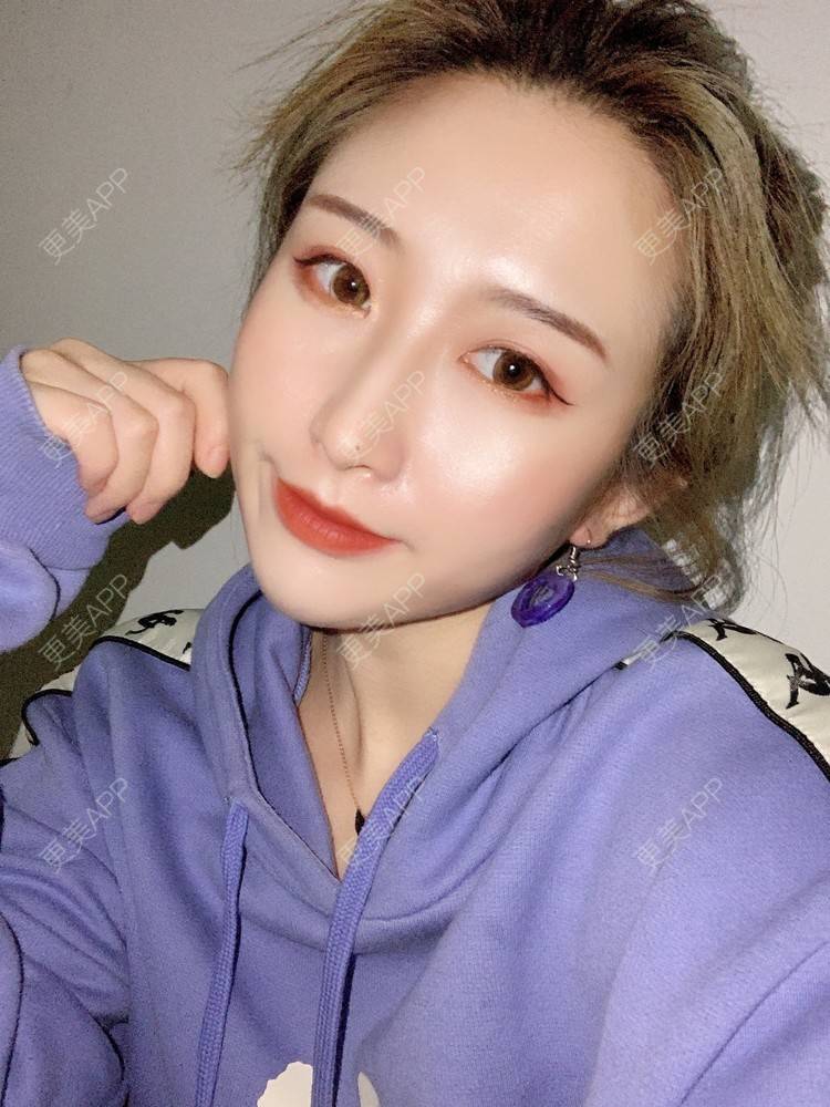 更美 - 更美用户KtaWOoiEh5的埋线提升经验 | 埋线提升 | 东莞