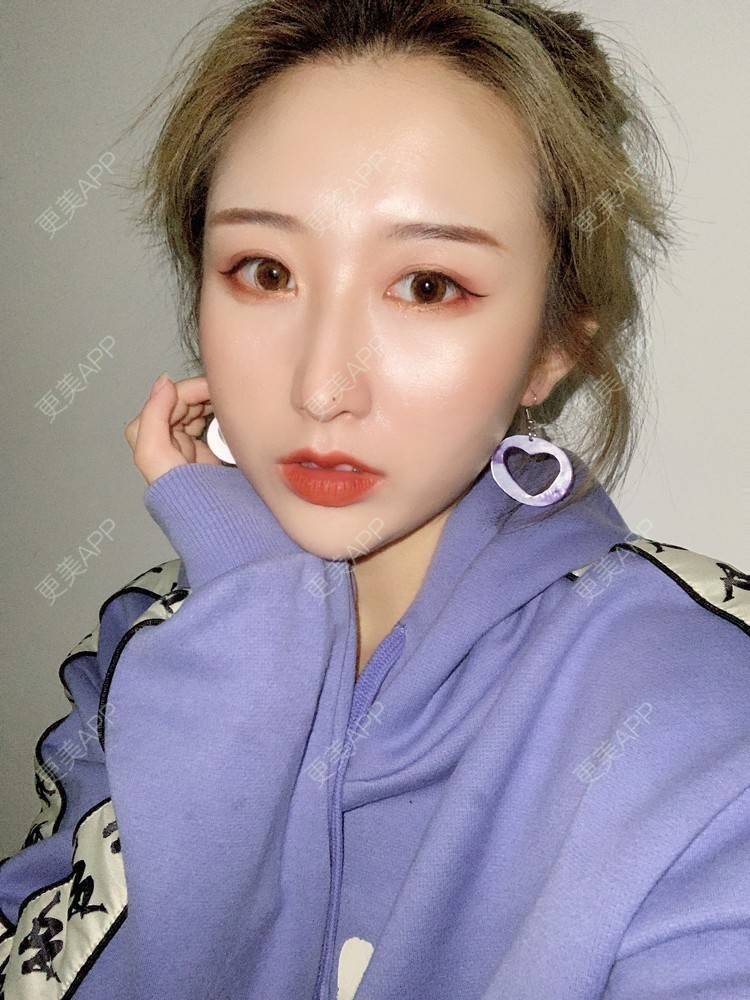 更美 - 更美用户KtaWOoiEh5的埋线提升经验 | 埋线提升 | 东莞