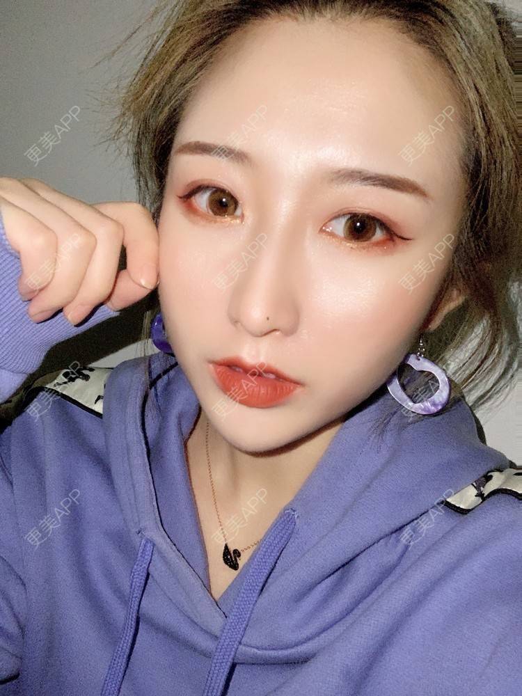 更美 - 更美用户KtaWOoiEh5的埋线提升经验 | 埋线提升 | 东莞