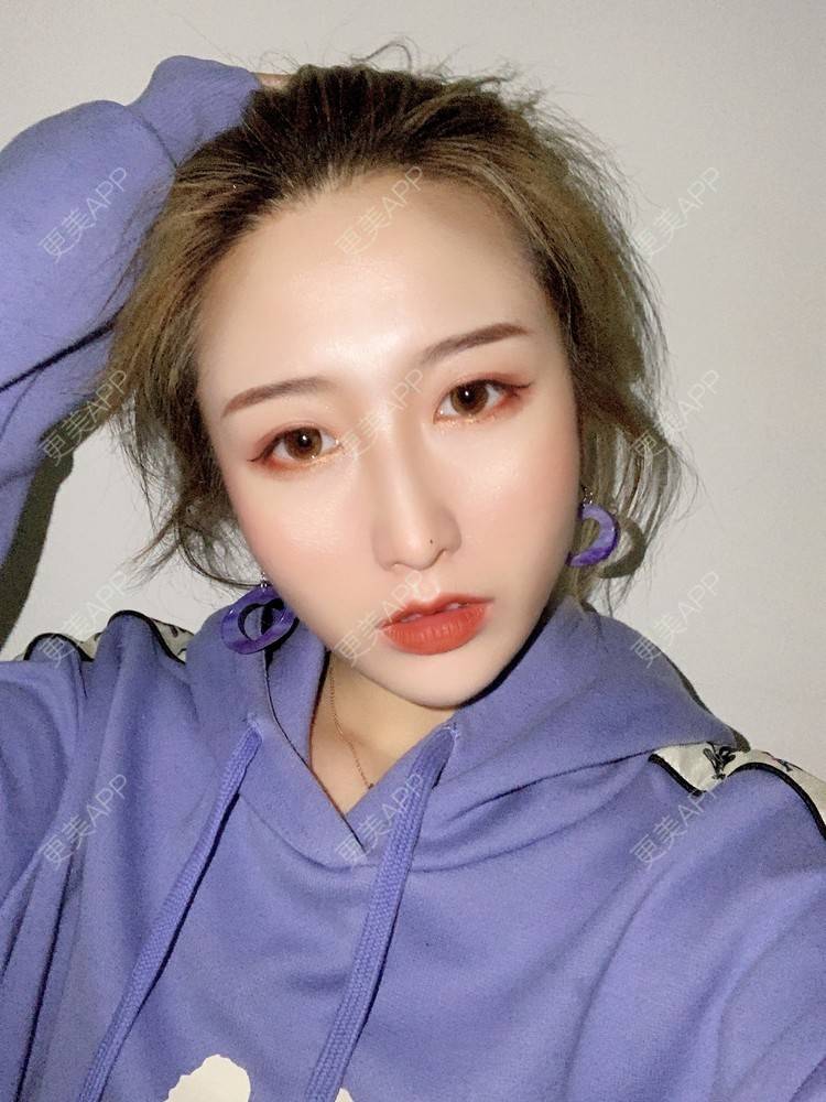 更美 - 更美用户KtaWOoiEh5的埋线提升经验 | 埋线提升 | 东莞
