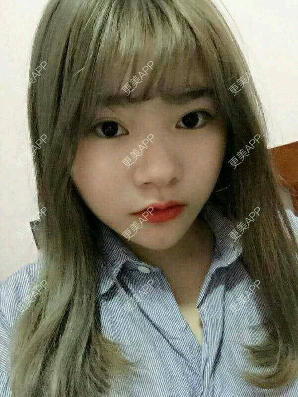 更美 - 更美用户TGYeipwLsJ的硅胶垫下巴经验 | 硅胶垫下巴 | 成都