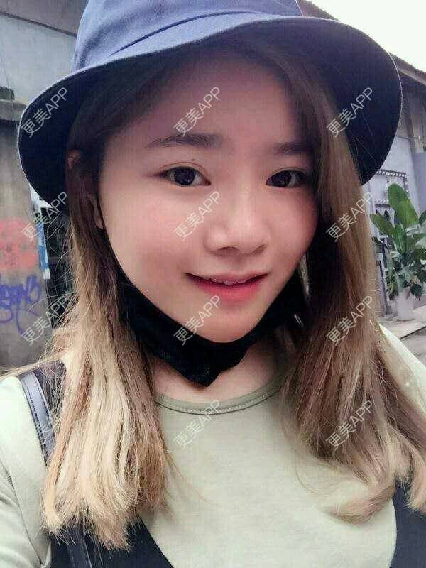 更美 - 更美用户TGYeipwLsJ的硅胶垫下巴经验 | 硅胶垫下巴 | 成都