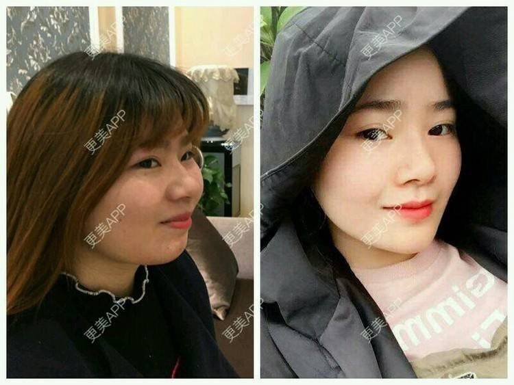 更美 - 更美用户TGYeipwLsJ的硅胶垫下巴经验 | 硅胶垫下巴 | 成都