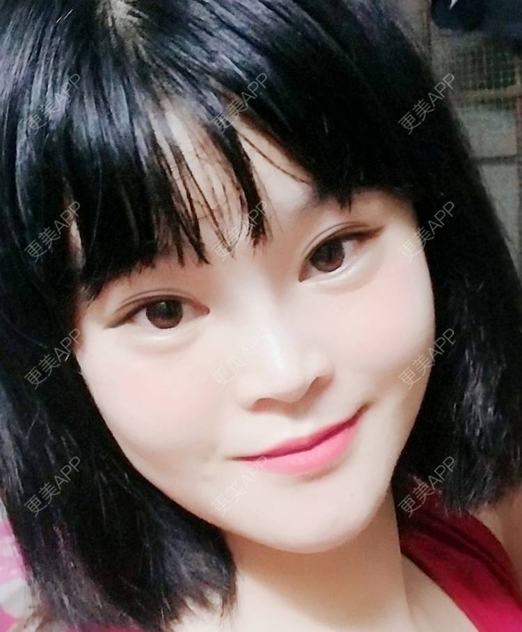 更美 - 风也温柔～的双眼皮经验 | 开外眼角 | 双眼皮 | 广州