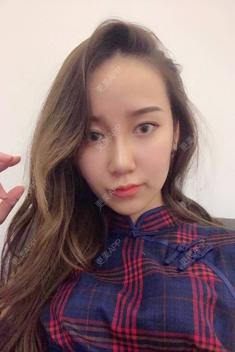 更美 - 更美用户cA33i6DxJX的玻尿酸鼻部经验 | 玻尿酸鼻部 | 上饶