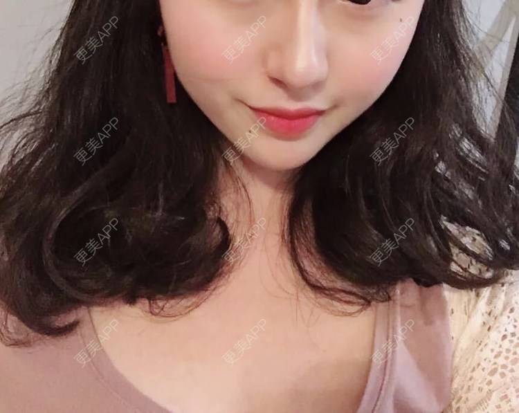 更美 - 更美用户cA33i6DxJX的玻尿酸下巴经验 | 玻尿酸下巴 | 上饶