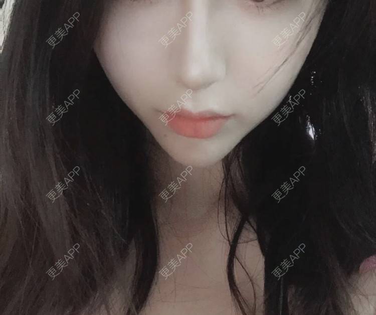 更美 - 更美用户cA33i6DxJX的玻尿酸下巴经验 | 玻尿酸下巴 | 上饶