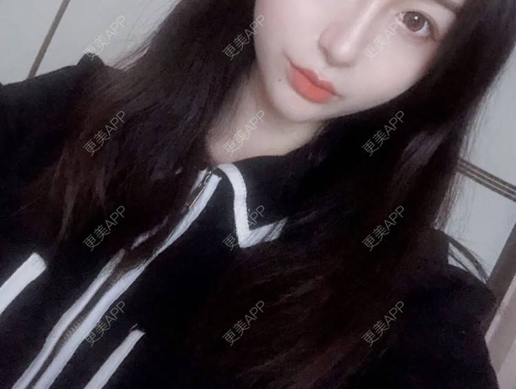 更美 - 更美用户cA33i6DxJX的玻尿酸下巴经验 | 玻尿酸下巴 | 上饶