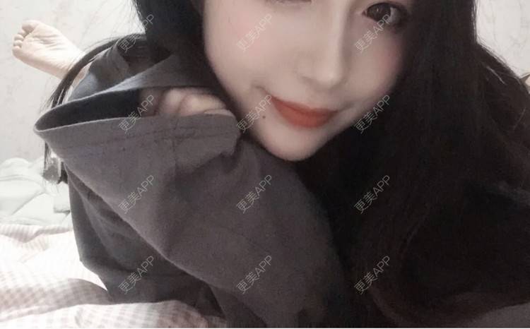 更美 - 更美用户cA33i6DxJX的玻尿酸下巴经验 | 玻尿酸下巴 | 上饶