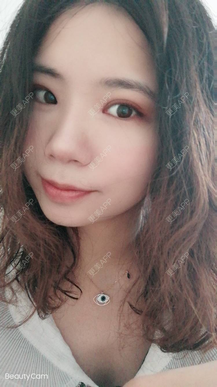 更美 - 墨七轩的双眼皮经验 | 双眼皮 | 全切双眼皮 | 开内眼角 | 开外眼角 | 杭州