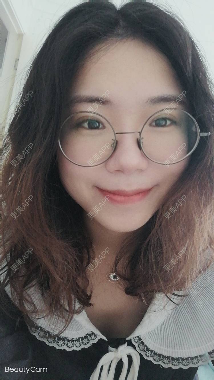 更美 - 墨七轩的双眼皮经验 | 双眼皮 | 全切双眼皮 | 开内眼角 | 开外眼角 | 杭州