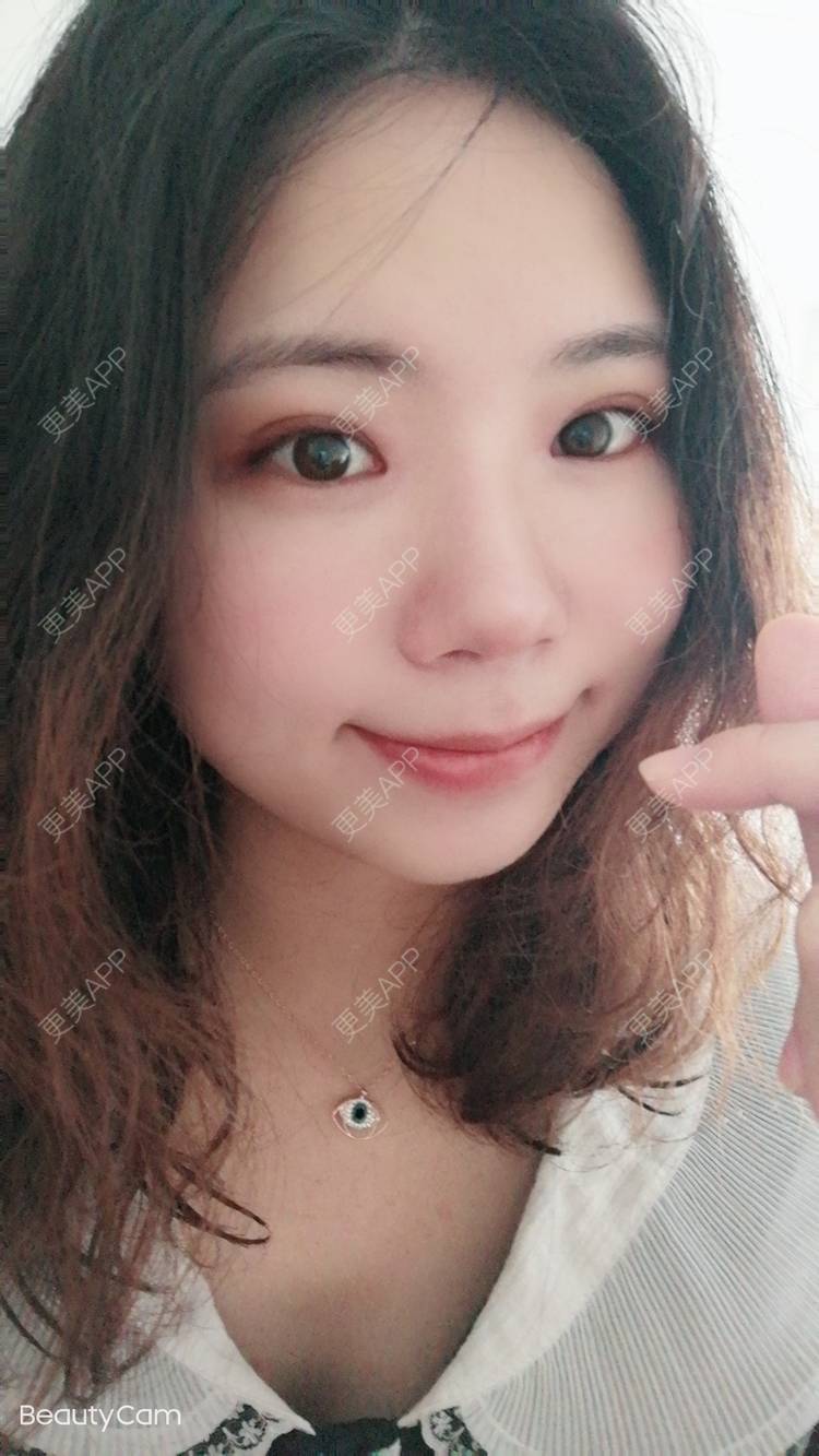 更美 - 墨七轩的双眼皮经验 | 双眼皮 | 全切双眼皮 | 开内眼角 | 开外眼角 | 杭州