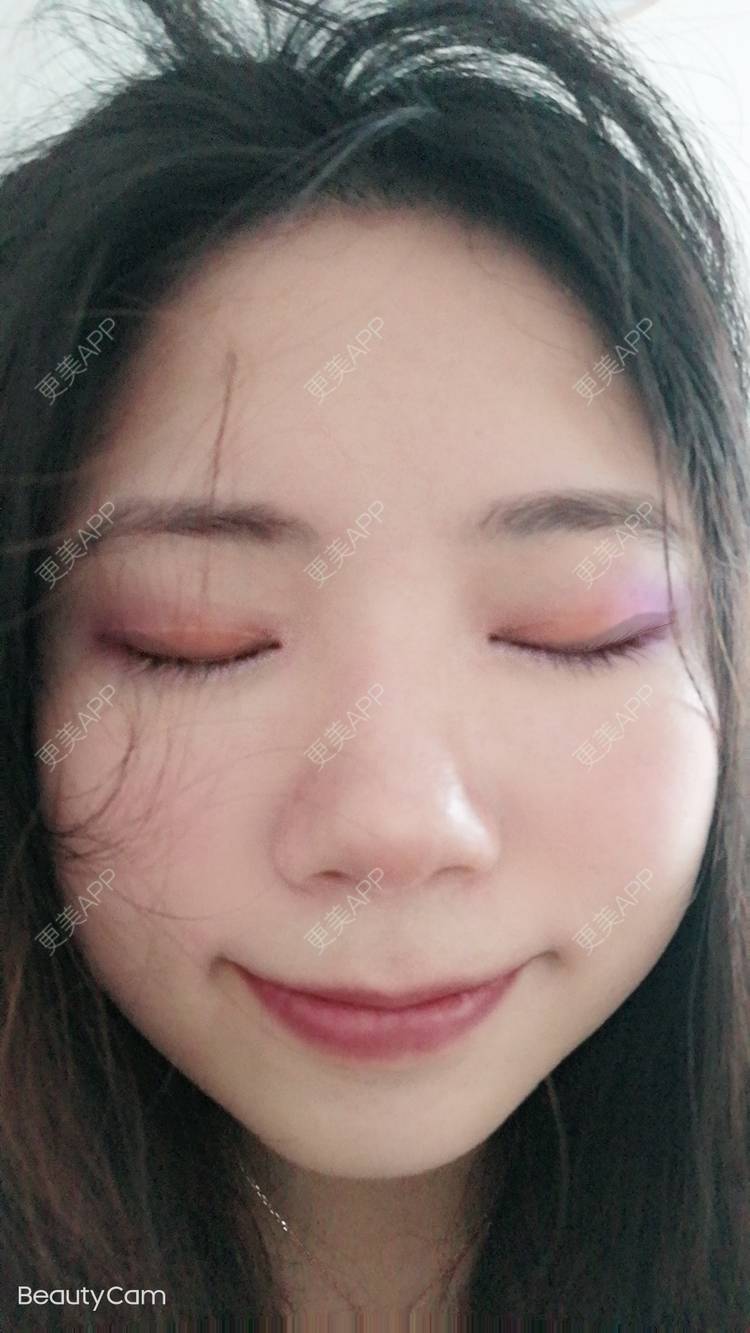 更美 - 墨七轩的双眼皮经验 | 双眼皮 | 全切双眼皮 | 开内眼角 | 开外眼角 | 杭州