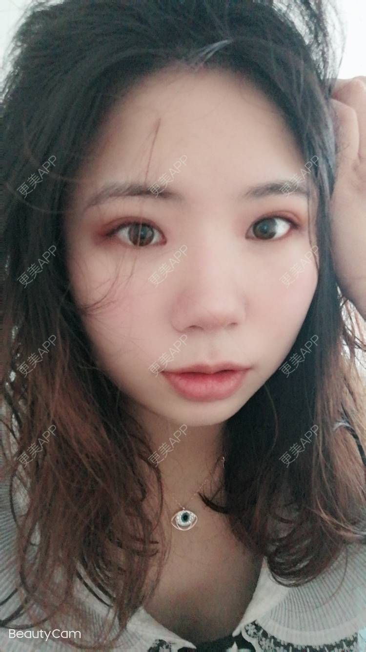 更美 - 墨七轩的双眼皮经验 | 双眼皮 | 全切双眼皮 | 开内眼角 | 开外眼角 | 杭州