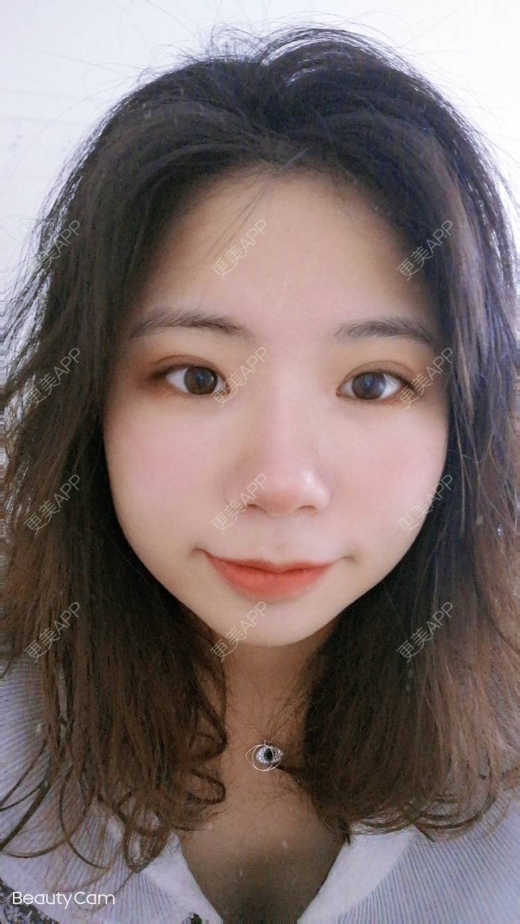 更美 - 墨七轩的双眼皮经验 | 双眼皮 | 全切双眼皮 | 开内眼角 | 开外眼角 | 杭州