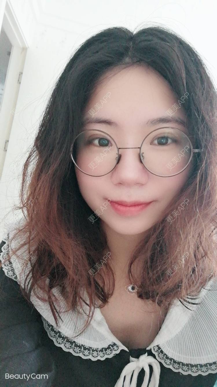 更美 - 墨七轩的双眼皮经验 | 双眼皮 | 全切双眼皮 | 开内眼角 | 开外眼角 | 杭州