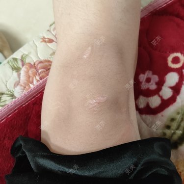 老疤感觉已经褪色的疤痕要怎么祛除