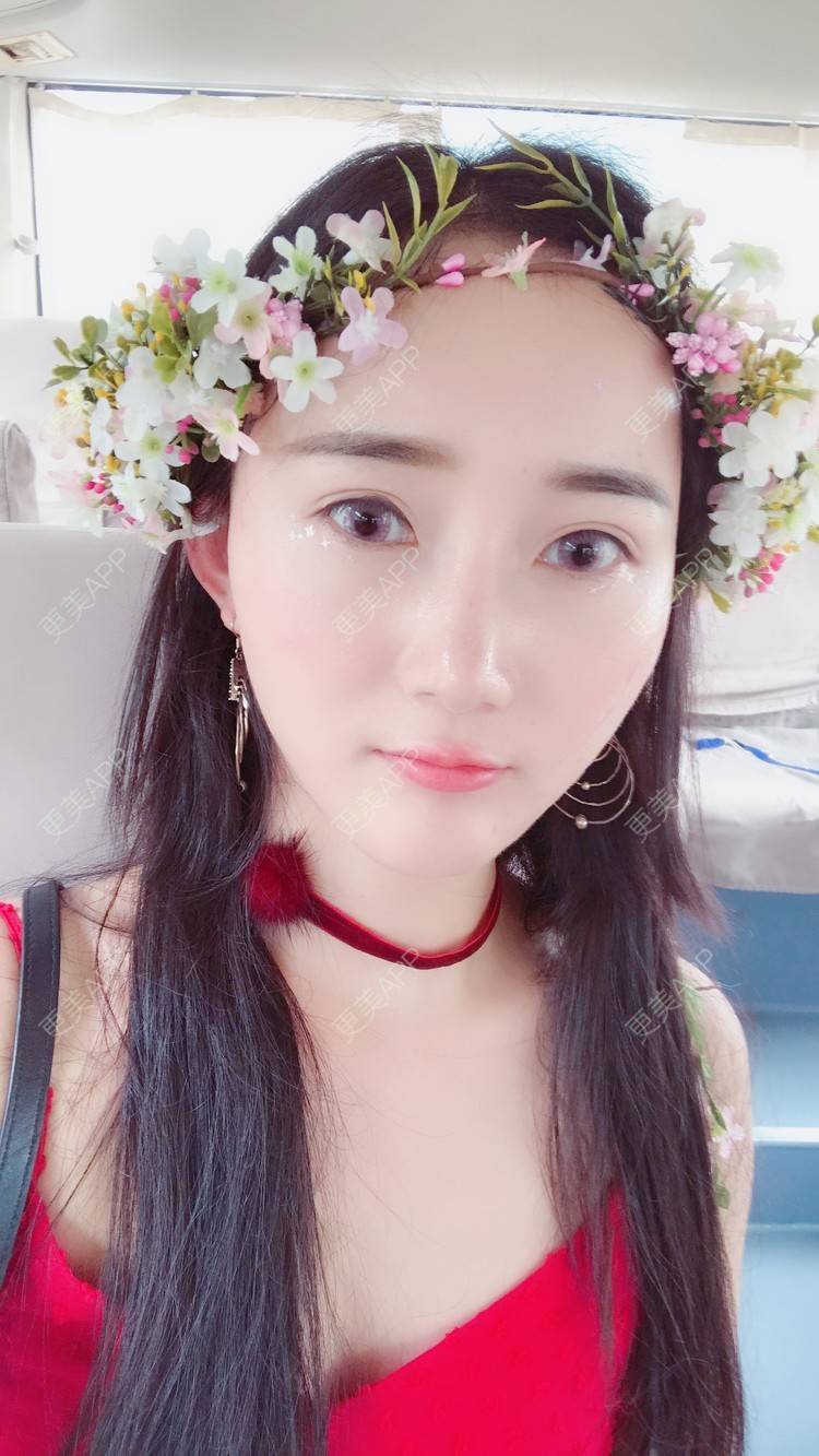 更美 - 卷毛甜心的自体脂肪填充泪沟经验 | 自体脂肪填充泪沟 | 视频日记 | 自体脂肪全面部填充 | 自体脂肪垫鼻基底 | 自体脂肪丰面颊 | 上海 | 自体脂肪垫下巴