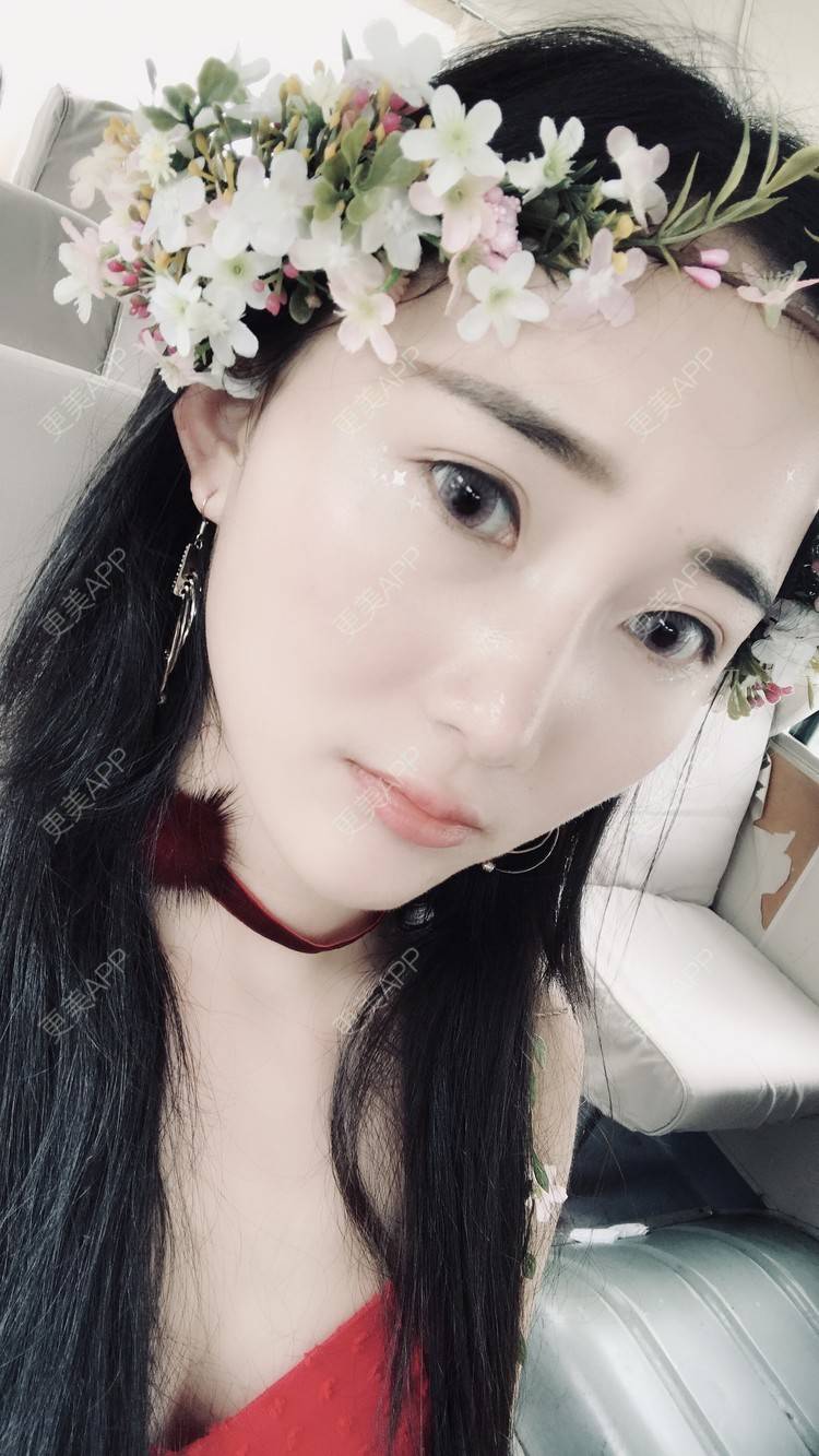 更美 - 卷毛甜心的自体脂肪填充泪沟经验 | 自体脂肪填充泪沟 | 视频日记 | 自体脂肪全面部填充 | 自体脂肪垫鼻基底 | 自体脂肪丰面颊 | 上海 | 自体脂肪垫下巴