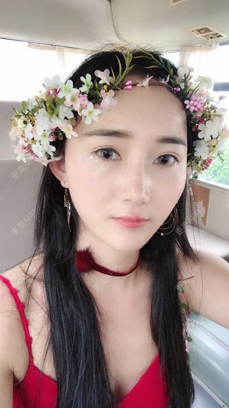 更美 - 卷毛甜心的自体脂肪填充泪沟经验 | 自体脂肪填充泪沟 | 视频日记 | 自体脂肪全面部填充 | 自体脂肪垫鼻基底 | 自体脂肪丰面颊 | 上海 | 自体脂肪垫下巴