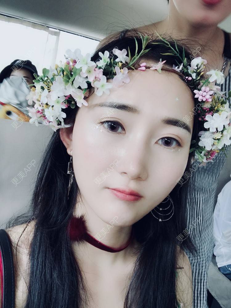 更美 - 卷毛甜心的自体脂肪填充泪沟经验 | 自体脂肪填充泪沟 | 视频日记 | 自体脂肪全面部填充 | 自体脂肪垫鼻基底 | 自体脂肪丰面颊 | 上海 | 自体脂肪垫下巴