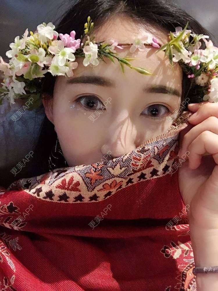 更美 - 卷毛甜心的自体脂肪填充泪沟经验 | 自体脂肪填充泪沟 | 视频日记 | 自体脂肪全面部填充 | 自体脂肪垫鼻基底 | 自体脂肪丰面颊 | 上海 | 自体脂肪垫下巴