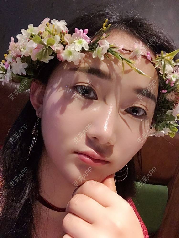 更美 - 卷毛甜心的自体脂肪填充泪沟经验 | 自体脂肪填充泪沟 | 视频日记 | 自体脂肪全面部填充 | 自体脂肪垫鼻基底 | 自体脂肪丰面颊 | 上海 | 自体脂肪垫下巴