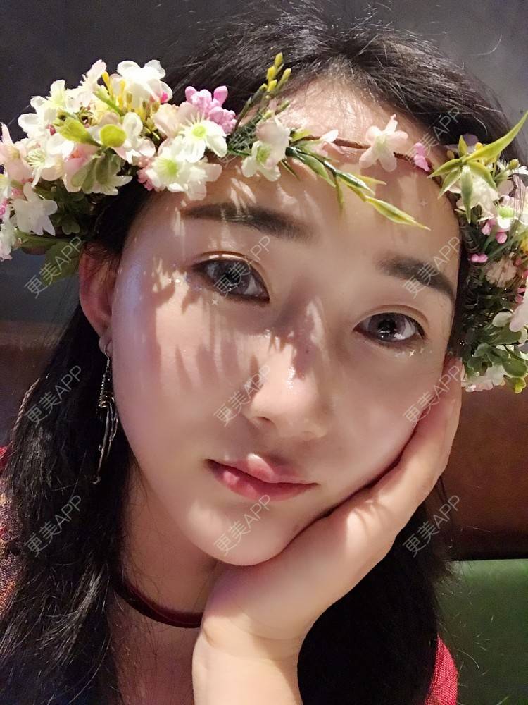 更美 - 卷毛甜心的自体脂肪填充泪沟经验 | 自体脂肪填充泪沟 | 视频日记 | 自体脂肪全面部填充 | 自体脂肪垫鼻基底 | 自体脂肪丰面颊 | 上海 | 自体脂肪垫下巴