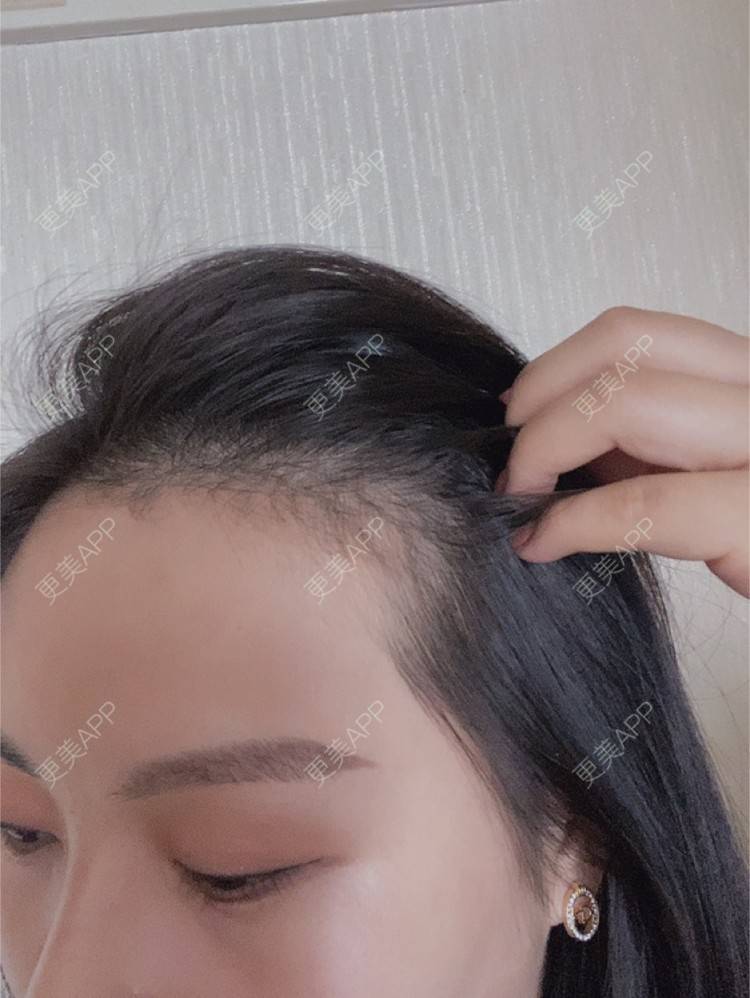 更美 - 更美用户WheNLesycN的半永久纹发际线经验 | 上海 | 半永久纹发际线