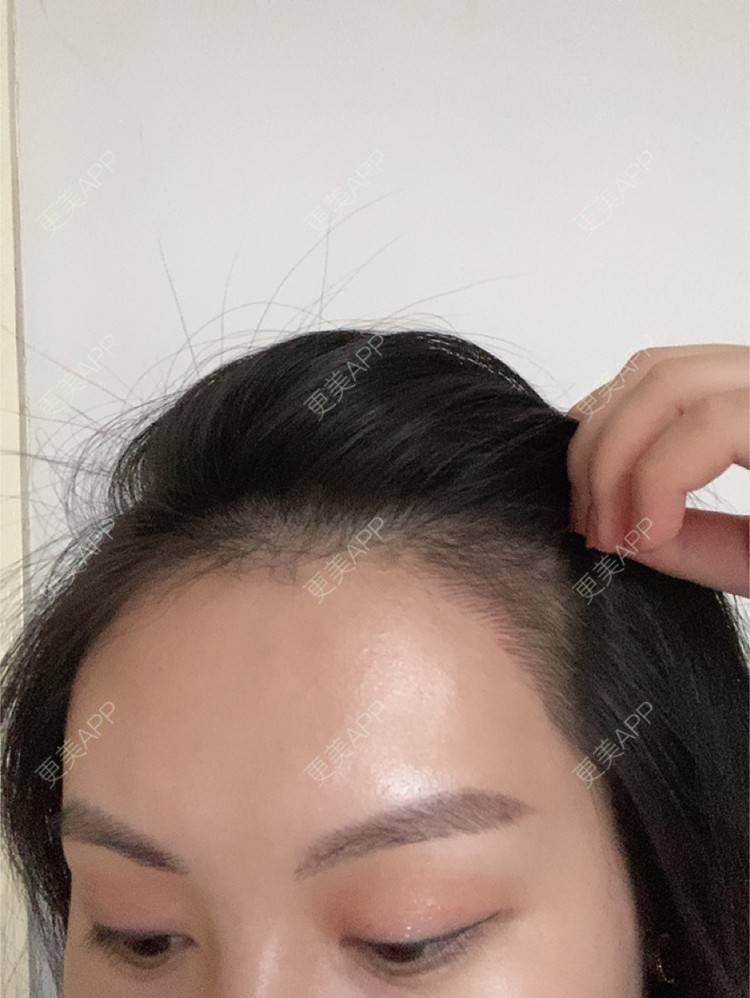 更美 - 更美用户WheNLesycN的半永久纹发际线经验 | 上海 | 半永久纹发际线