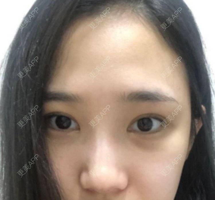 更美 - 冉冉吹起的胶原蛋白淡化黑眼圈经验 | 胶原蛋白淡化黑眼圈 | 北京